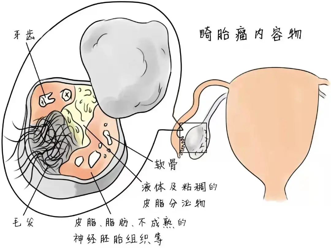 卵巢畸胎瘤100个人中有几个_卵巢畸胎瘤中期可以治愈率_卵巢里的畸胎瘤可以自己消失吗