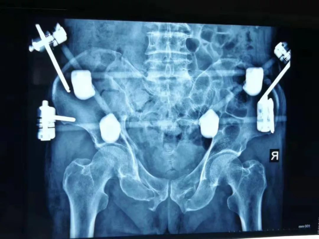 精湛醫術③骨盆骨折伴失血性休克微創外固定架為生命架起橋樑