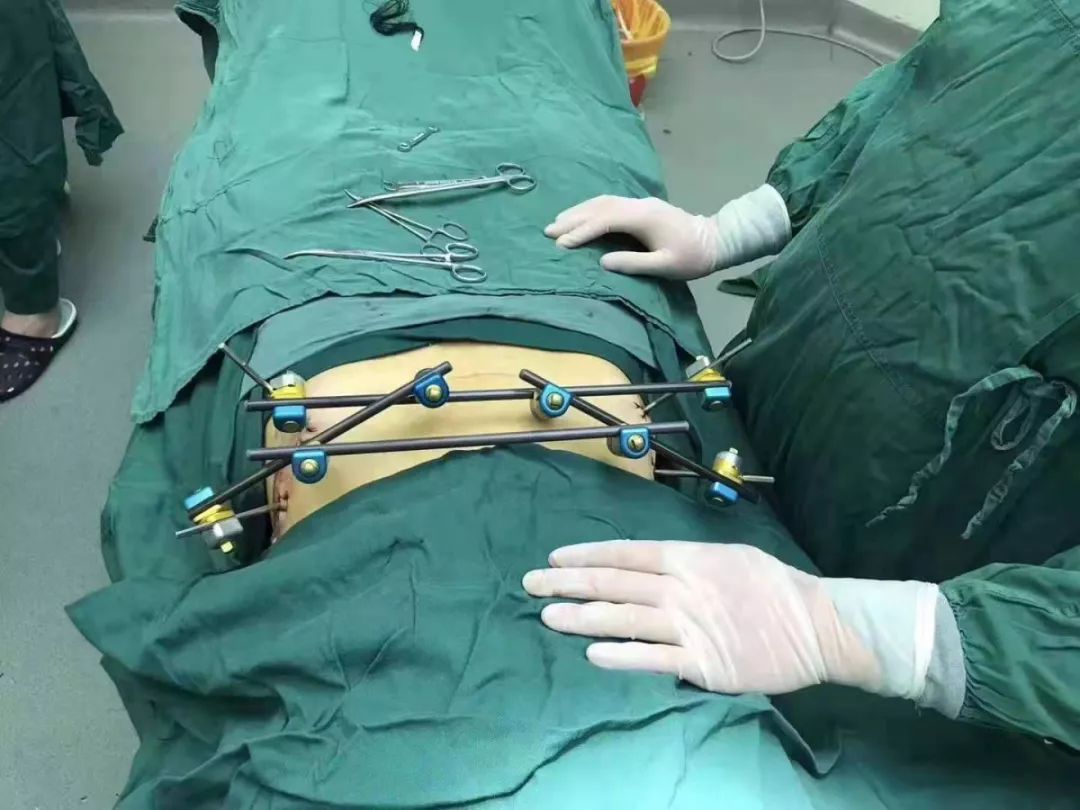 骨盆骨折伴失血性休克微创外固定架为生命架起桥梁
