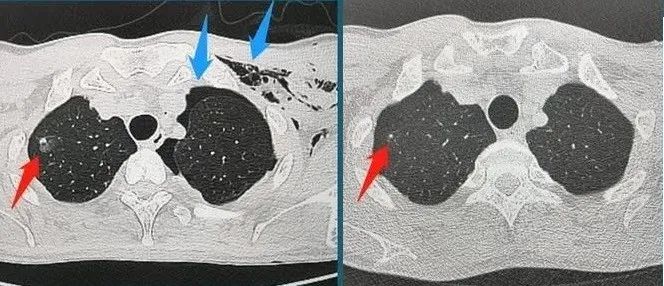 去年體檢還好好的，今年一查肺上就多出個結節來！它究竟是從哪來的？ 健康 第3張