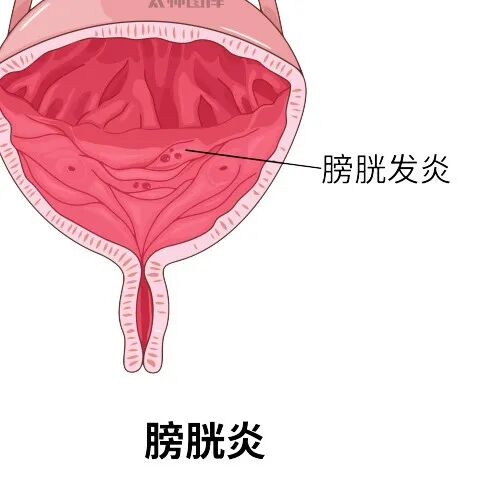 b膀胱镜为什么消毒关于膀胱镜，你要知道的都在这里！_https://www.jmylbn.com_新闻资讯_第4张