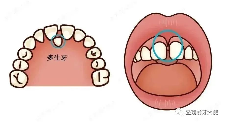 口腔科普 ⑦｜替牙期-如何正确迎接第二口牙？