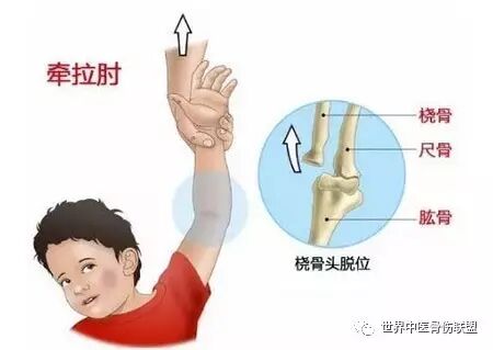 哪些动作可能伤到孩子的胳膊肘 世界中医骨伤联盟 微信公众号文章阅读 Wemp