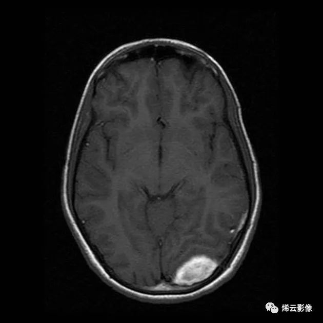 外 血腫 膜 硬