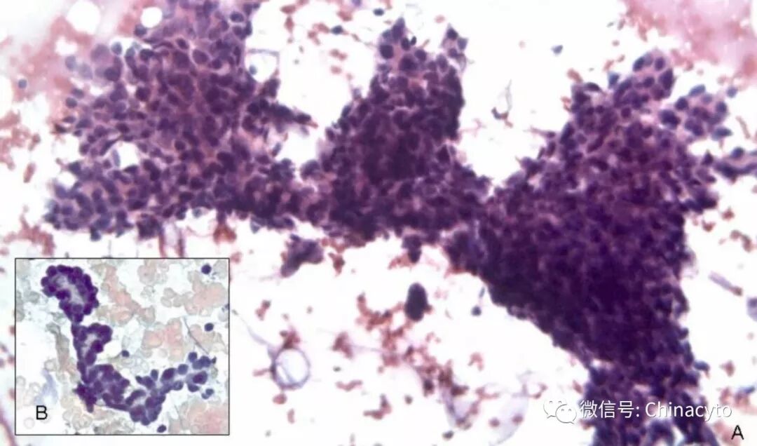 穿刺枪怎么升级乳腺穿刺术（二）_https://www.jmylbn.com_新闻资讯_第9张