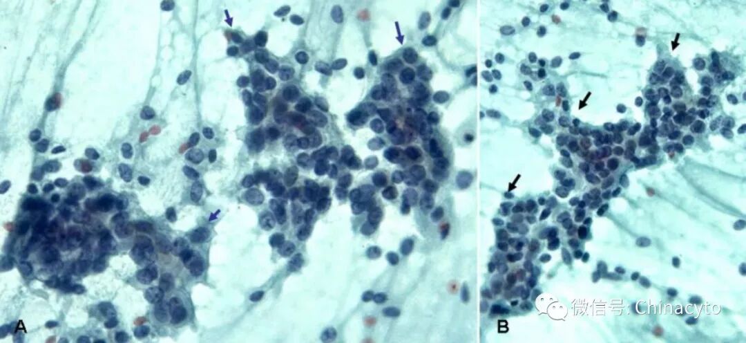 穿刺枪怎么升级乳腺穿刺术（二）_https://www.jmylbn.com_新闻资讯_第7张