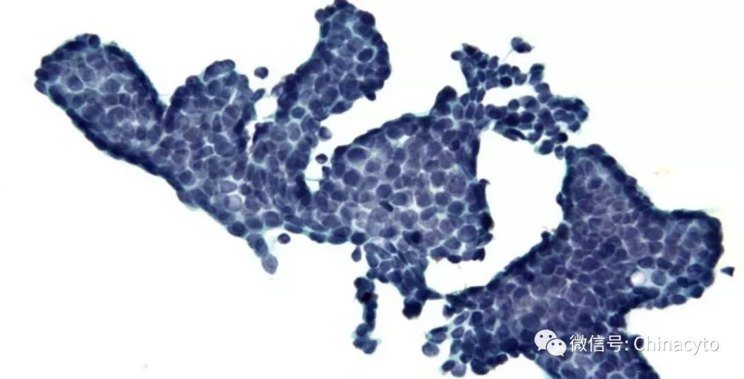 穿刺枪怎么升级乳腺穿刺术（二）_https://www.jmylbn.com_新闻资讯_第8张