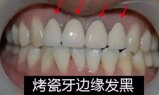 烤瓷牙变这样必须拆掉，否则有大麻烦