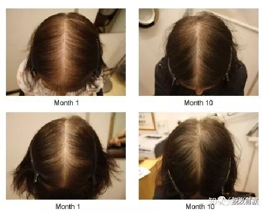 这是一篇针对女性脱发治疗最通俗有效的文章