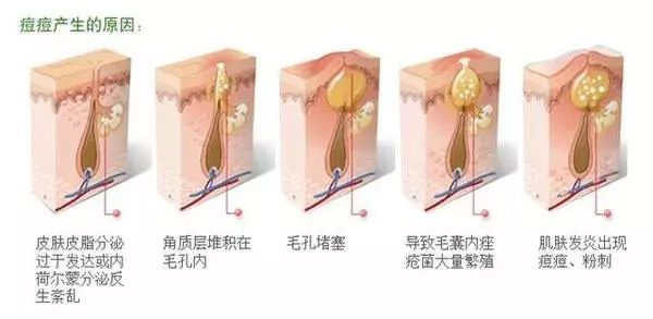 战“痘”的七大误区，你占了几个？