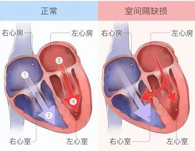 右心室位置图图片