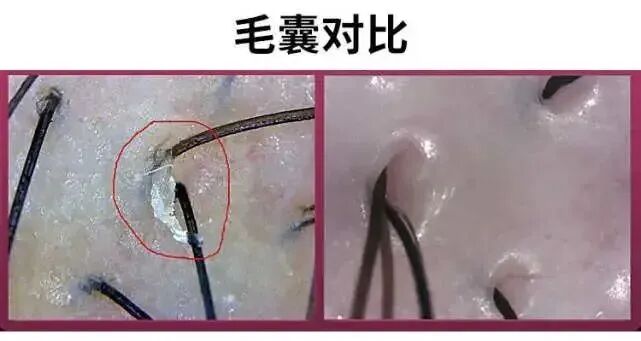 裸露在皮肤外的头发是从毛囊中长出来的.