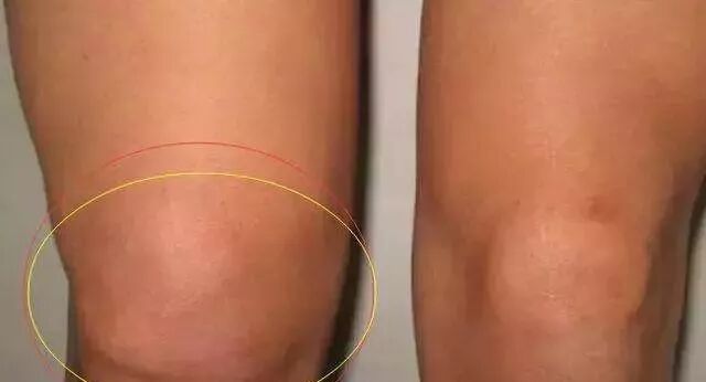 三七+丹参，是滑膜炎的良药，腿不疼了，半月板损伤走了