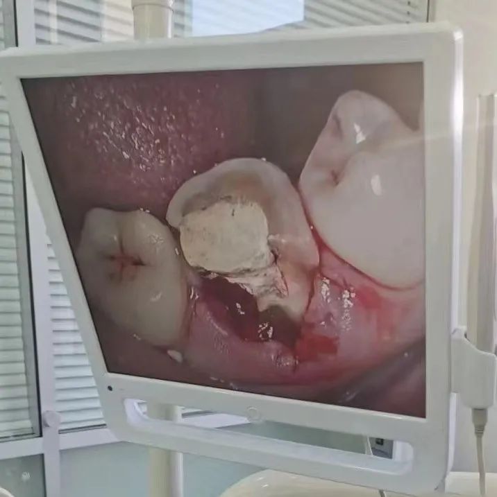 根管不做冠，早晚是后患！患者“不做冠”后牙齿劈成了两半