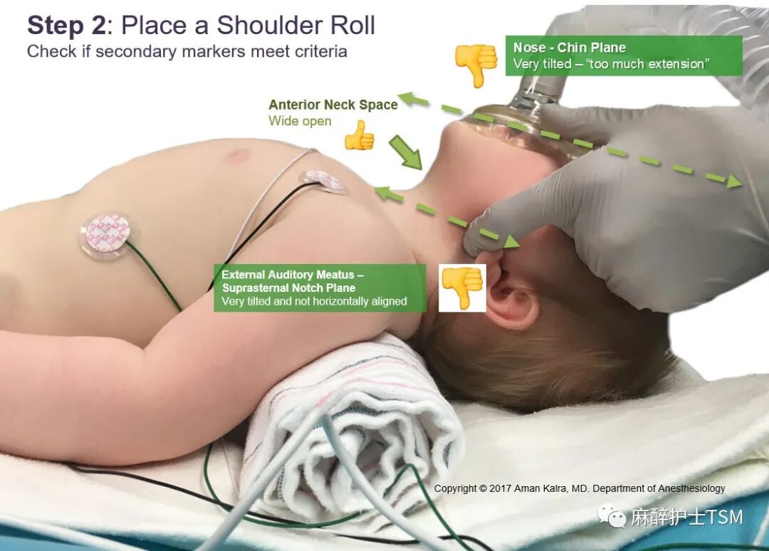 怎么呼吸麻醉麻醉和手术体位 - 呼吸系统的影响_https://www.jmylbn.com_新闻资讯_第19张