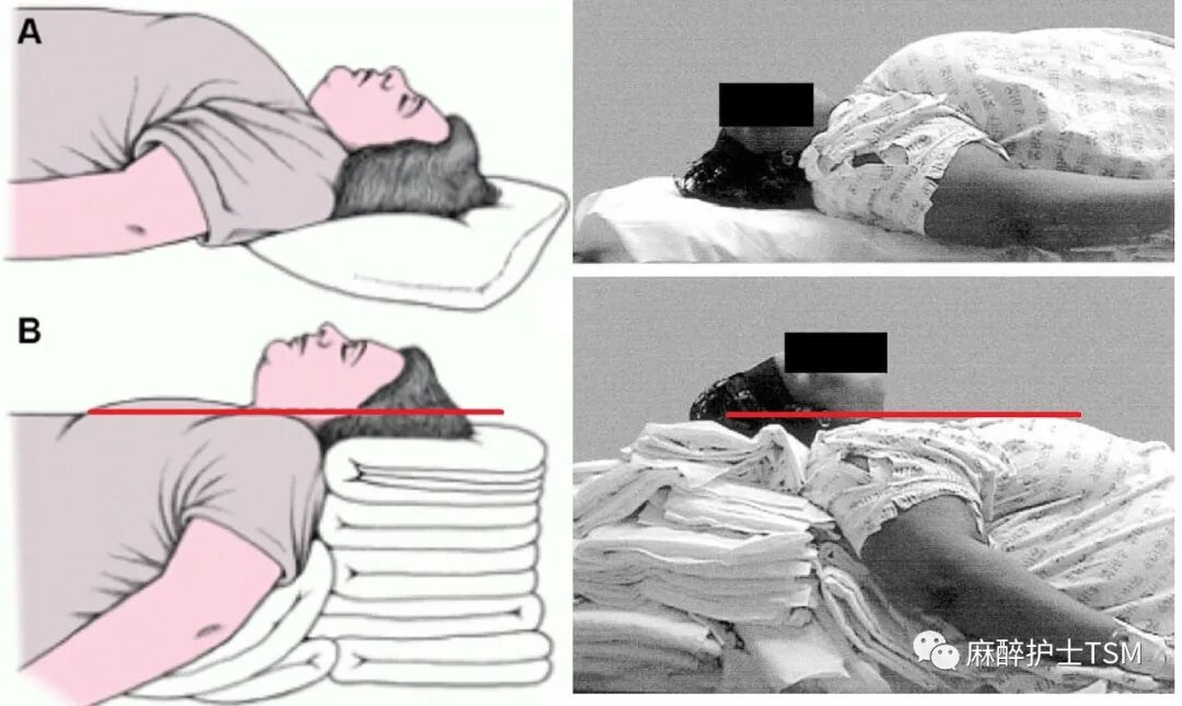 怎么呼吸麻醉麻醉和手术体位 - 呼吸系统的影响_https://www.jmylbn.com_新闻资讯_第13张