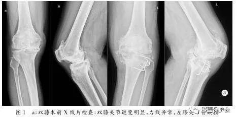 反覆膝蓋痛是滑膜炎前兆！出現這6個症狀，可要及早治療！ 健康 第6張