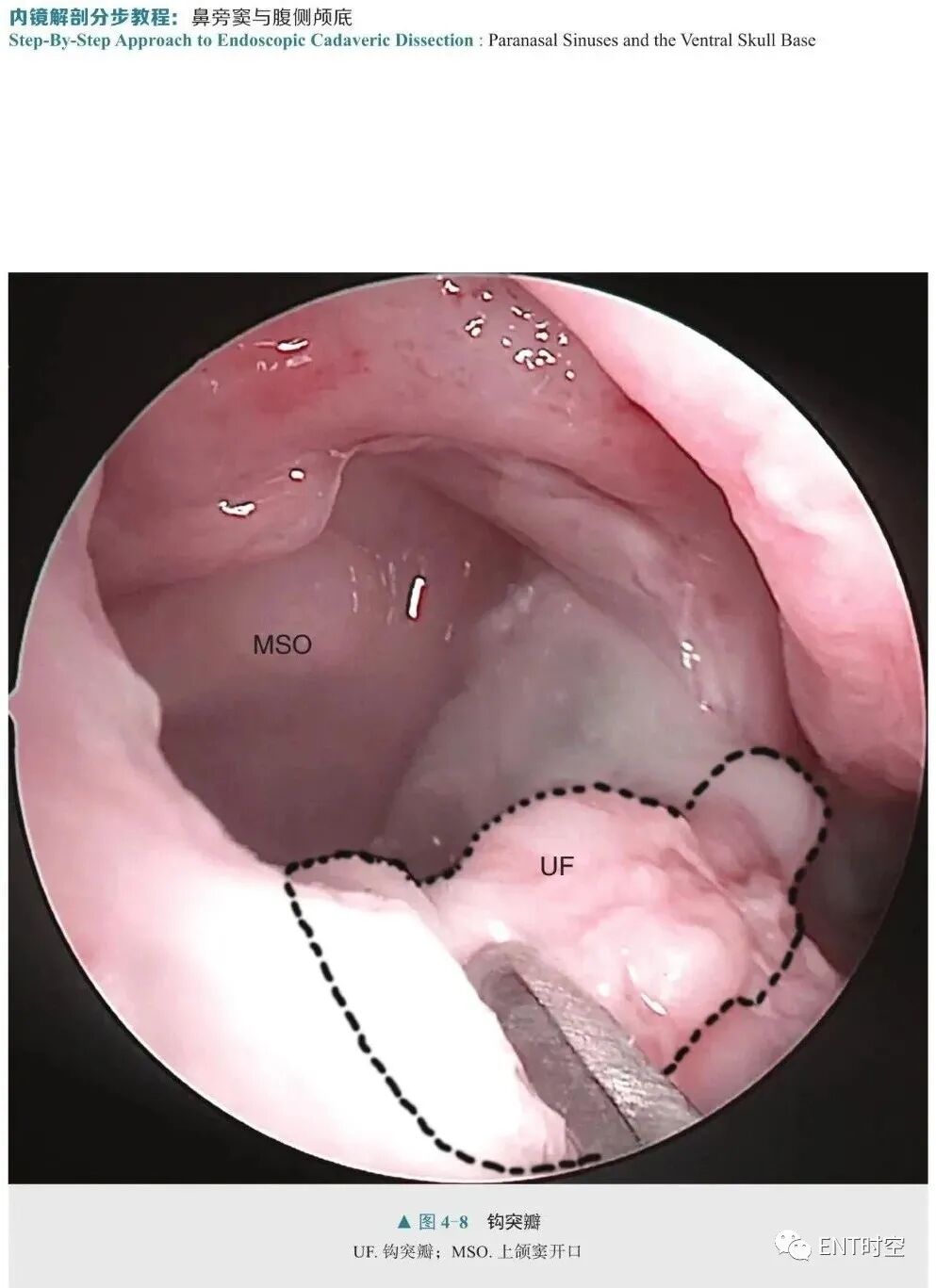 操作鼻窦镜时怎么摆内镜视角下的鼻、鼻旁窦及腹侧颅底手术解剖，双人四手操作的精髓！_https://www.jmylbn.com_新闻资讯_第7张