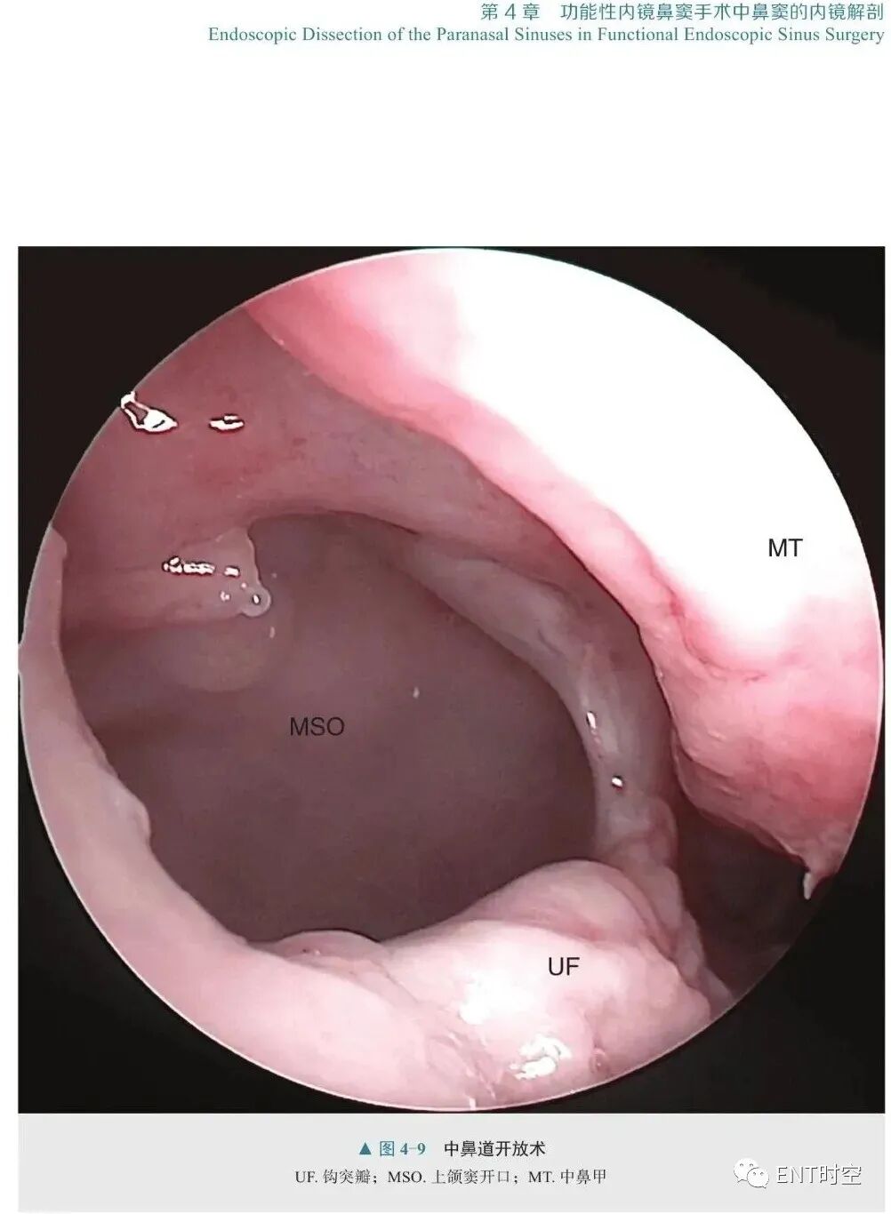 操作鼻窦镜时怎么摆内镜视角下的鼻、鼻旁窦及腹侧颅底手术解剖，双人四手操作的精髓！_https://www.jmylbn.com_新闻资讯_第8张