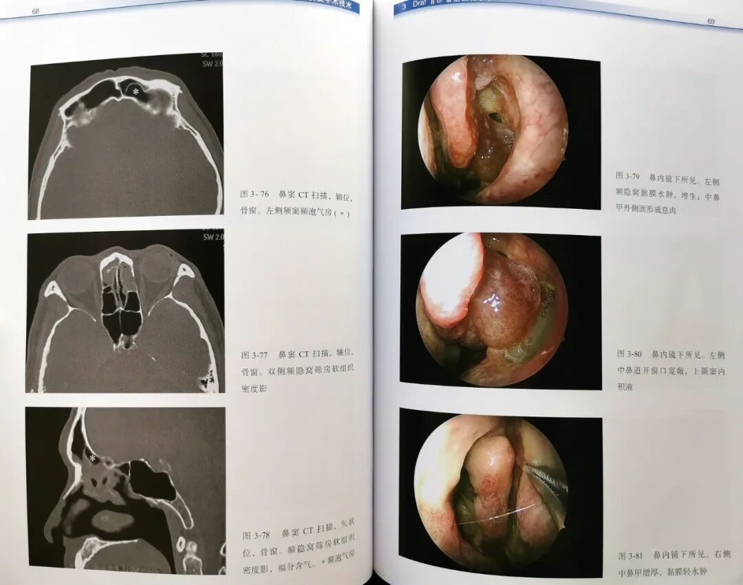 操作鼻窦镜时怎么摆带你解读FESS手术操作步骤和技巧（图文并茂附手术光盘）_https://www.jmylbn.com_新闻资讯_第11张
