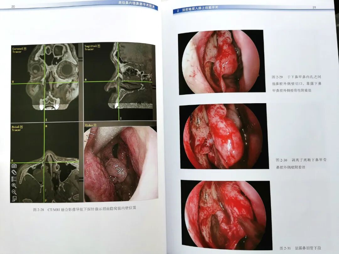 操作鼻窦镜时怎么摆带你解读FESS手术操作步骤和技巧（图文并茂附手术光盘）_https://www.jmylbn.com_新闻资讯_第9张