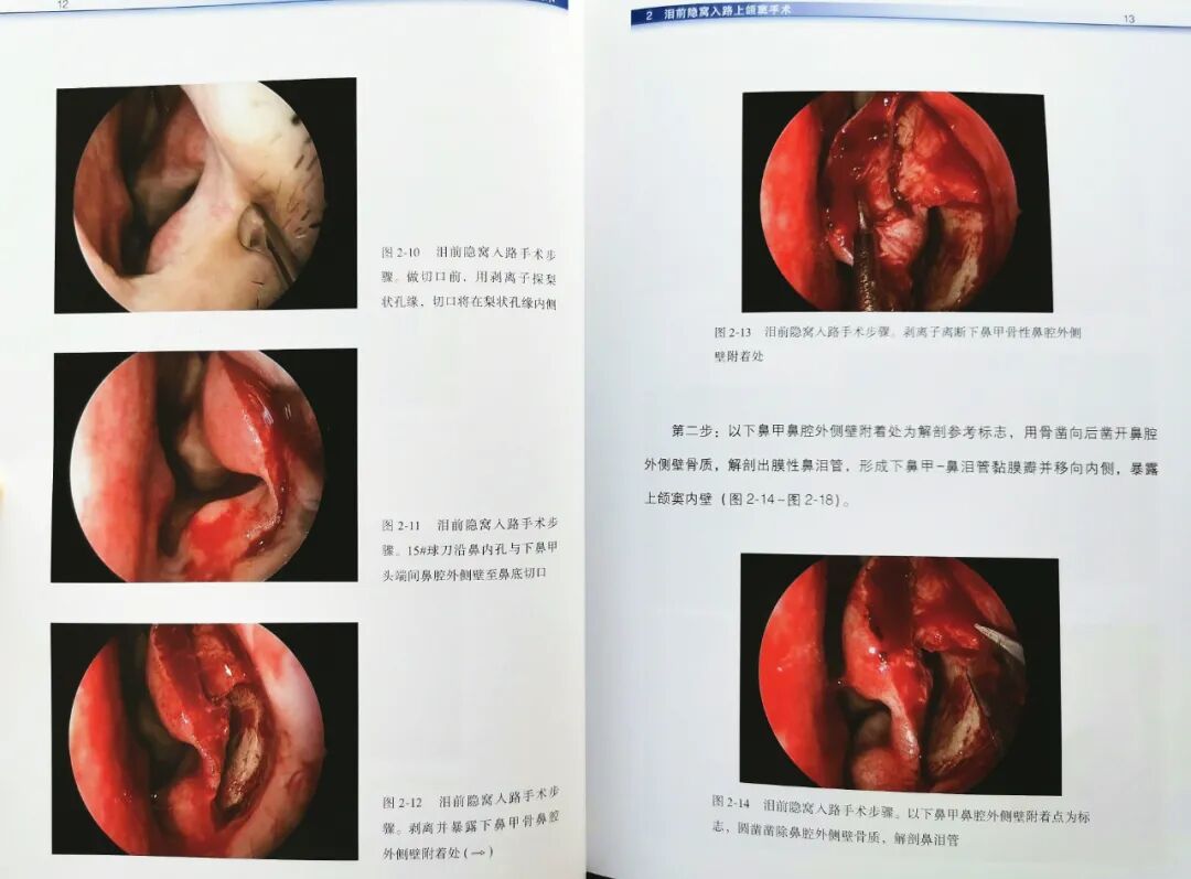 操作鼻窦镜时怎么摆带你解读FESS手术操作步骤和技巧（图文并茂附手术光盘）_https://www.jmylbn.com_新闻资讯_第8张