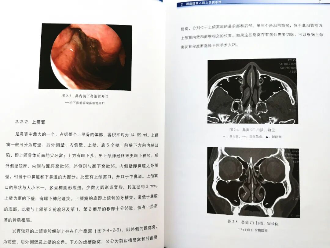 操作鼻窦镜时怎么摆带你解读FESS手术操作步骤和技巧（图文并茂附手术光盘）_https://www.jmylbn.com_新闻资讯_第7张