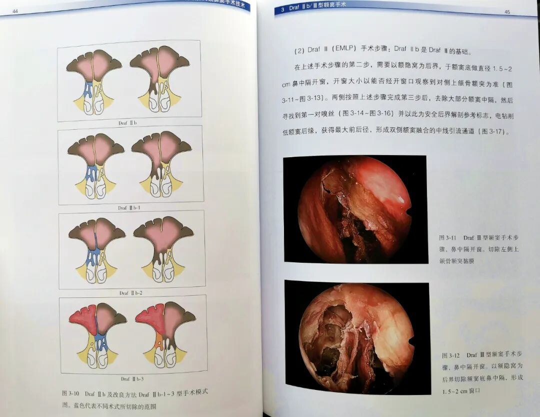 操作鼻窦镜时怎么摆带你解读FESS手术操作步骤和技巧（图文并茂附手术光盘）_https://www.jmylbn.com_新闻资讯_第10张