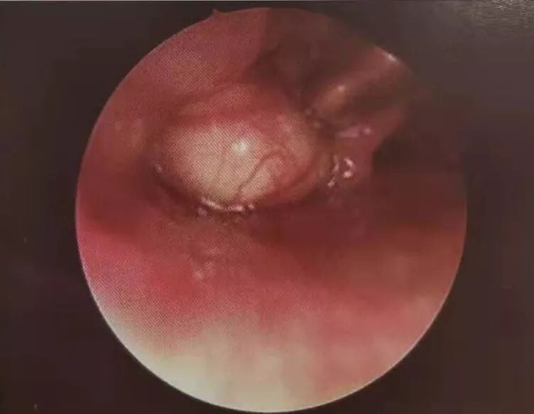 等离子刀头怎么使用等离子射频会厌囊肿切除术，手把手教学！（上篇）_https://www.jmylbn.com_新闻资讯_第2张