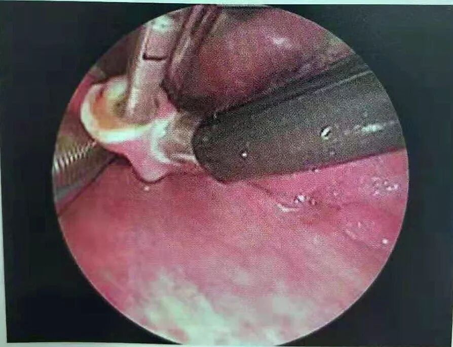 等离子刀头怎么使用等离子射频会厌囊肿切除术，手把手教学！（上篇）_https://www.jmylbn.com_新闻资讯_第12张