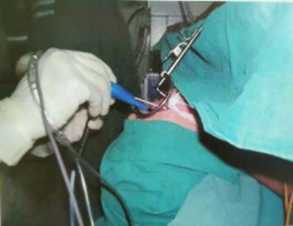 等离子刀头怎么使用等离子射频会厌囊肿切除术，手把手教学！（上篇）_https://www.jmylbn.com_新闻资讯_第4张