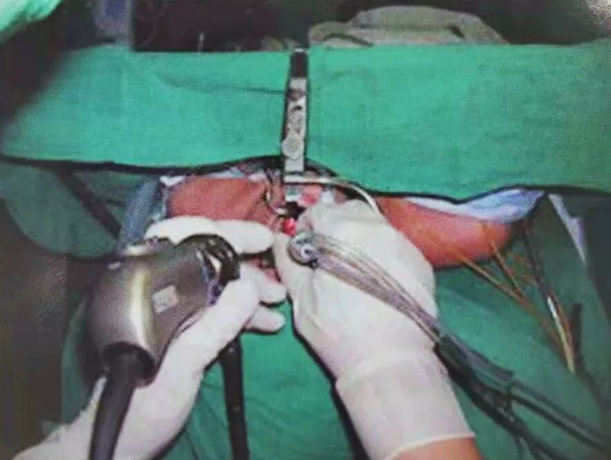 等离子刀头怎么使用等离子射频会厌囊肿切除术，手把手教学！（上篇）_https://www.jmylbn.com_新闻资讯_第5张