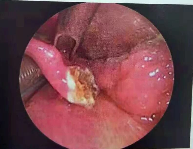 等离子刀头怎么使用等离子射频会厌囊肿切除术，手把手教学！（上篇）_https://www.jmylbn.com_新闻资讯_第13张