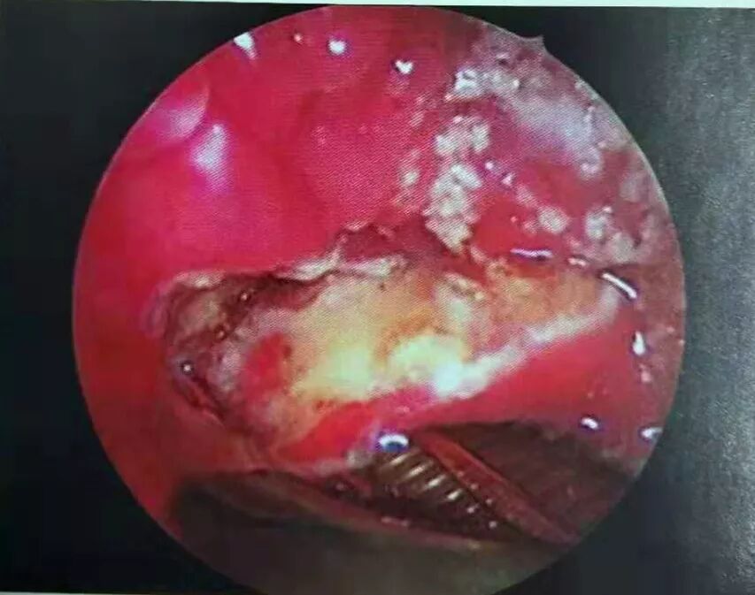 等离子刀头怎么使用等离子射频会厌囊肿切除术，手把手教学！（上篇）_https://www.jmylbn.com_新闻资讯_第15张