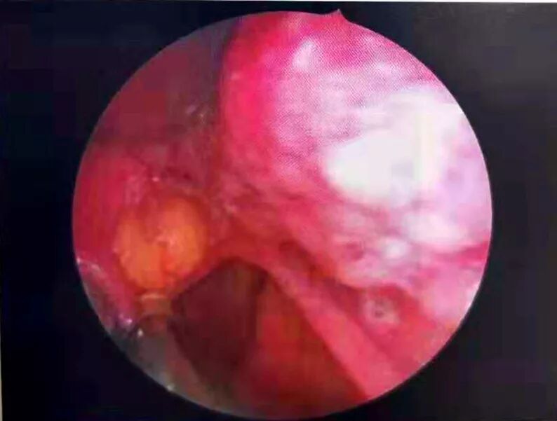 等离子刀头怎么使用等离子射频会厌囊肿切除术，手把手教学！（上篇）_https://www.jmylbn.com_新闻资讯_第8张