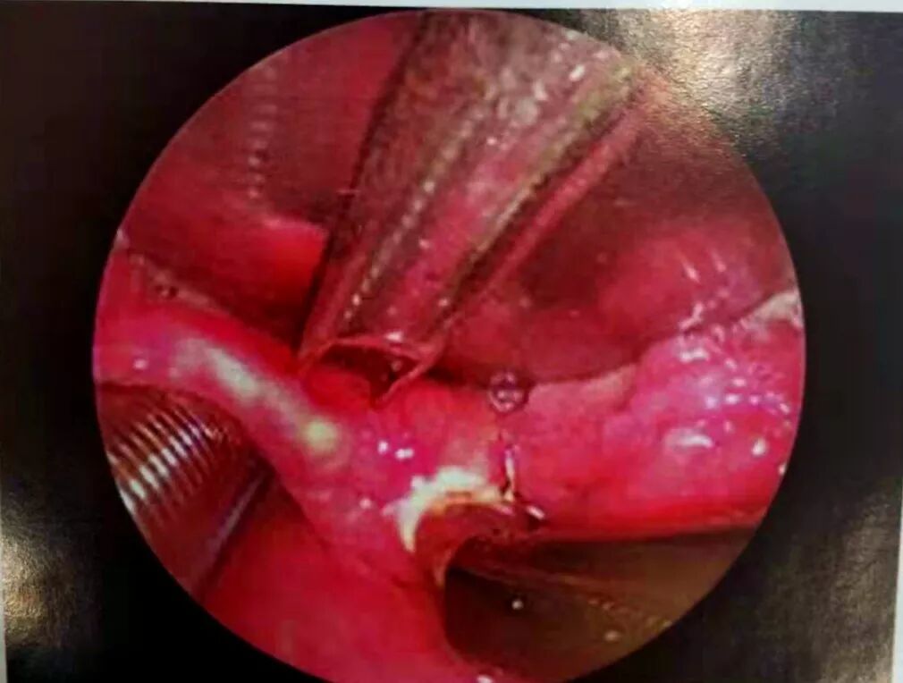 等离子刀头怎么使用等离子射频会厌囊肿切除术，手把手教学！（上篇）_https://www.jmylbn.com_新闻资讯_第11张