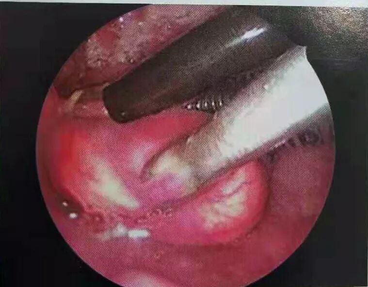 等离子刀头怎么使用等离子射频会厌囊肿切除术，手把手教学！（上篇）_https://www.jmylbn.com_新闻资讯_第14张