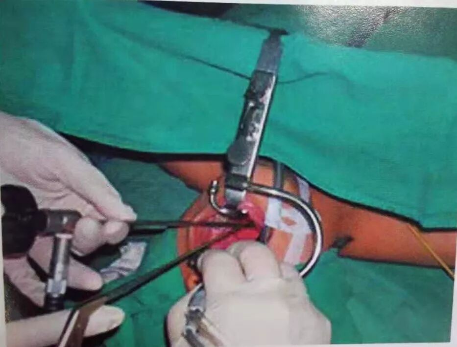 等离子刀头怎么使用等离子射频会厌囊肿切除术，手把手教学！（上篇）_https://www.jmylbn.com_新闻资讯_第7张