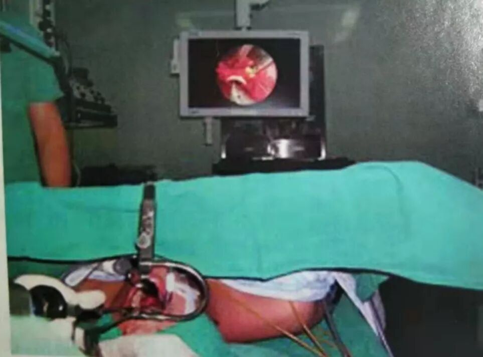 等离子刀头怎么使用等离子射频会厌囊肿切除术，手把手教学！（上篇）_https://www.jmylbn.com_新闻资讯_第6张