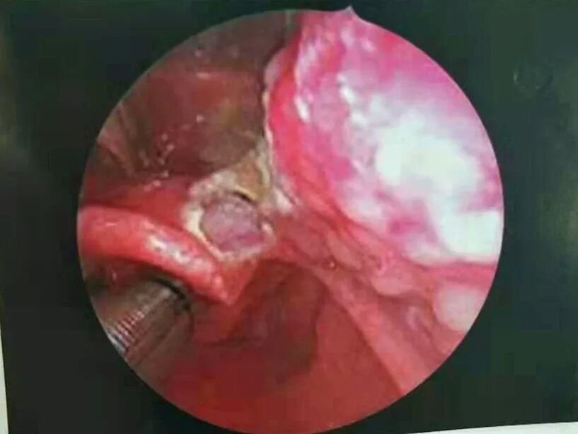 等离子刀头怎么使用等离子射频会厌囊肿切除术，手把手教学！（上篇）_https://www.jmylbn.com_新闻资讯_第9张