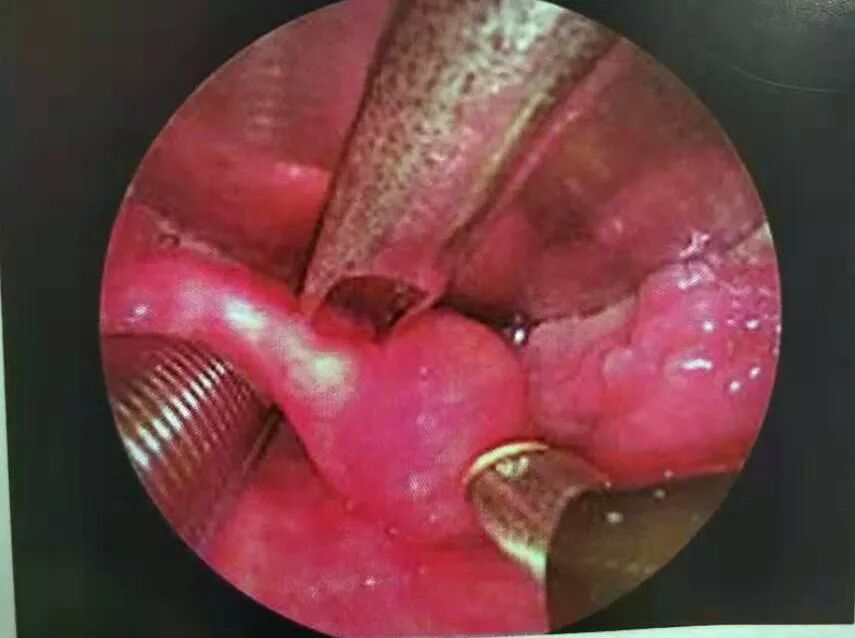 等离子刀头怎么使用等离子射频会厌囊肿切除术，手把手教学！（上篇）_https://www.jmylbn.com_新闻资讯_第10张