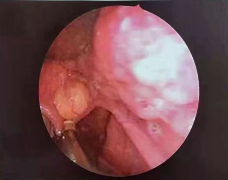 等离子刀头怎么使用等离子射频会厌囊肿切除术，手把手教学！（上篇）_https://www.jmylbn.com_新闻资讯_第3张