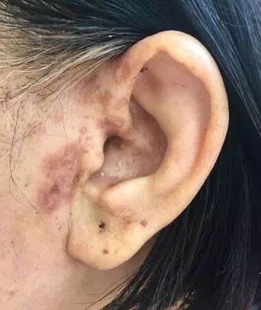 耳带状疱疹(hunt综合症)