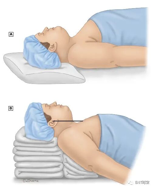 喉镜是怎么麻醉掌握这份喉镜检查秘籍，你也可以是喉镜检查高手！_https://www.jmylbn.com_新闻资讯_第2张