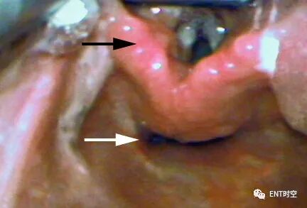喉镜是怎么麻醉掌握这份喉镜检查秘籍，你也可以是喉镜检查高手！_https://www.jmylbn.com_新闻资讯_第3张
