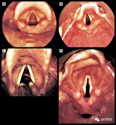 喉镜是怎么麻醉掌握这份喉镜检查秘籍，你也可以是喉镜检查高手！_https://www.jmylbn.com_新闻资讯_第1张