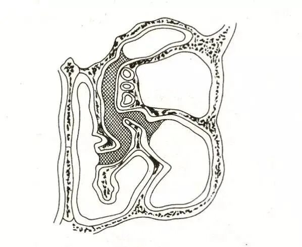 操作鼻窦镜时怎么摆基础必备 丨 鼻内镜鼻窦手术的操作过程详解_https://www.jmylbn.com_新闻资讯_第3张