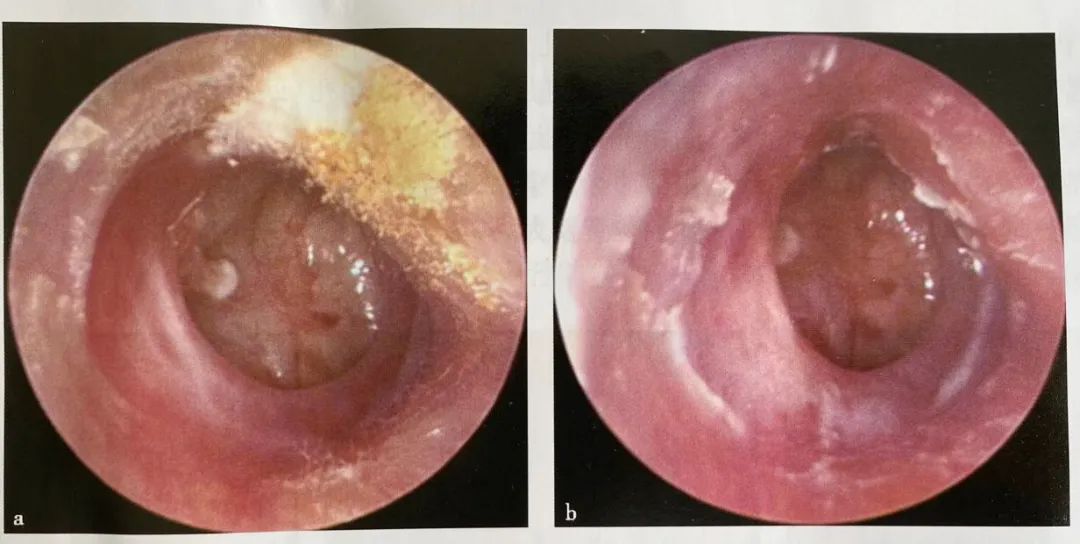 耳鼻喉镜篇耳内镜下治疗慢性化脓性中耳炎