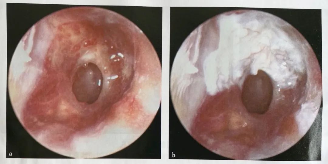 鼓膜肉芽组织,减少耳漏,促进干耳2,耳内镜下对鼓膜及鼓室进行精准评