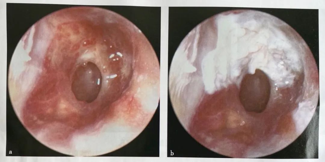 中耳炎耳镜检查图片图片